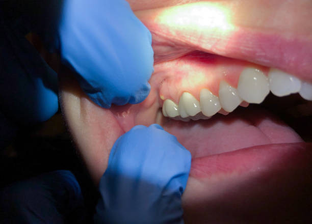 Best Emergency Dental Extractions in Pinetops, NC